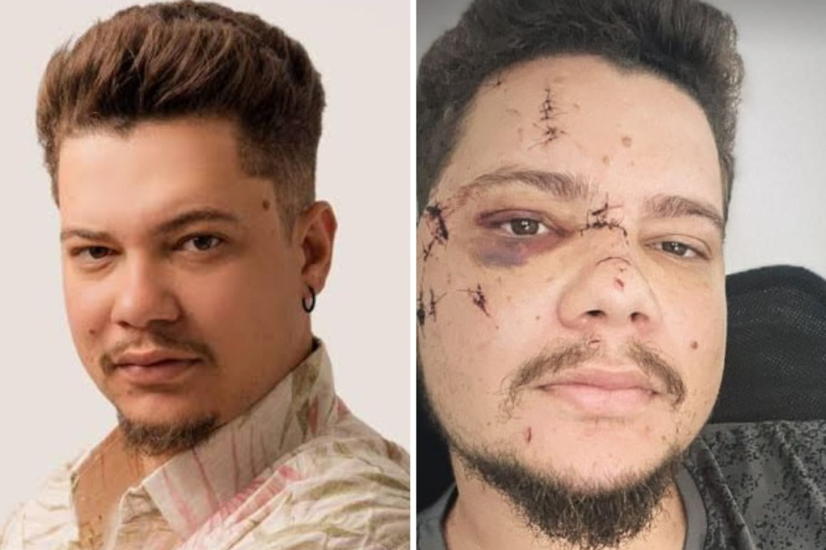 Sertanejo Benício é agredido com garrafada após show e enfrenta recuperação difícil