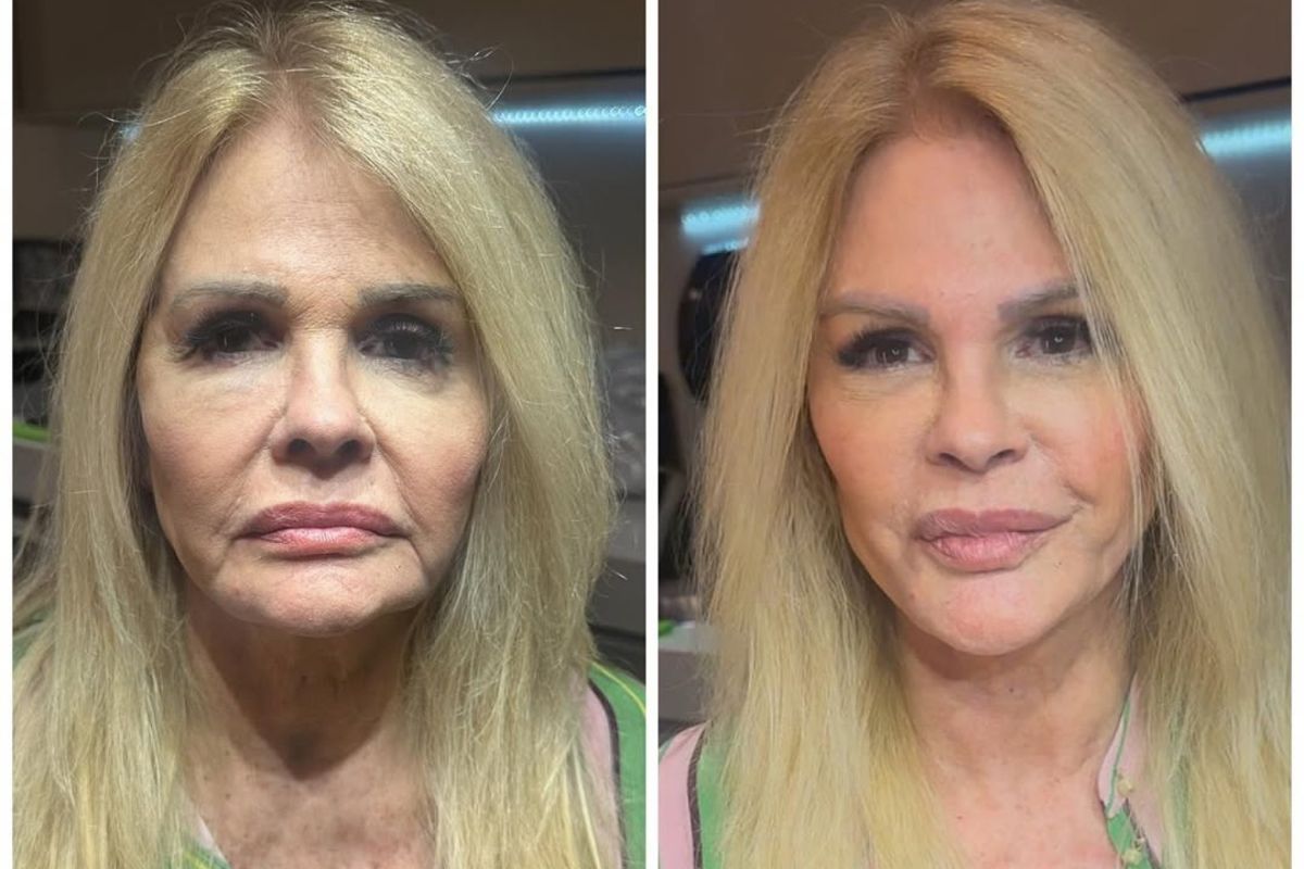 Monique Evans surpreende com antes e depois de procedimento