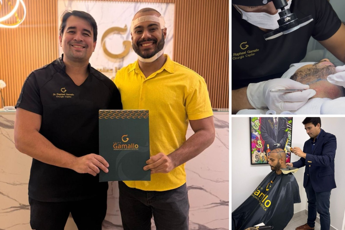 Ex-BBB Marcus Vinicius faz novo transplante capilar após trauma
