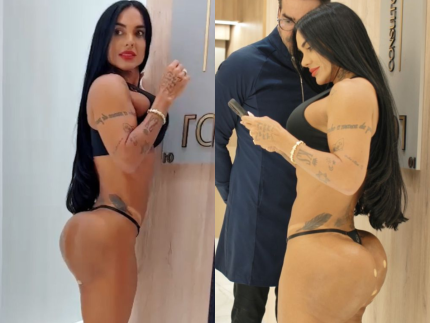 Especialista explica uso do PMMA em procedimento de Kamila Simioni para correção no bumbum