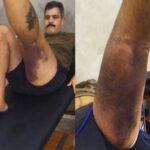 Juliano Cazarré passa por reabilitação após nova cirurgia e expõe hematomas