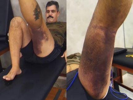 Juliano Cazarré passa por reabilitação após nova cirurgia e expõe hematomas