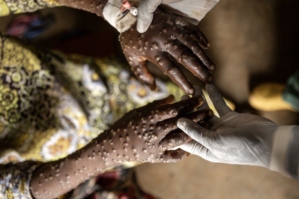 OMS mantém alerta global para epidemia de Mpox